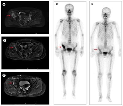 Long term survival achieved through combination of almonertinib and pyrotinib in EGFR-mutant/HER2-amplified advanced NSCLC patient: a case report and literature review